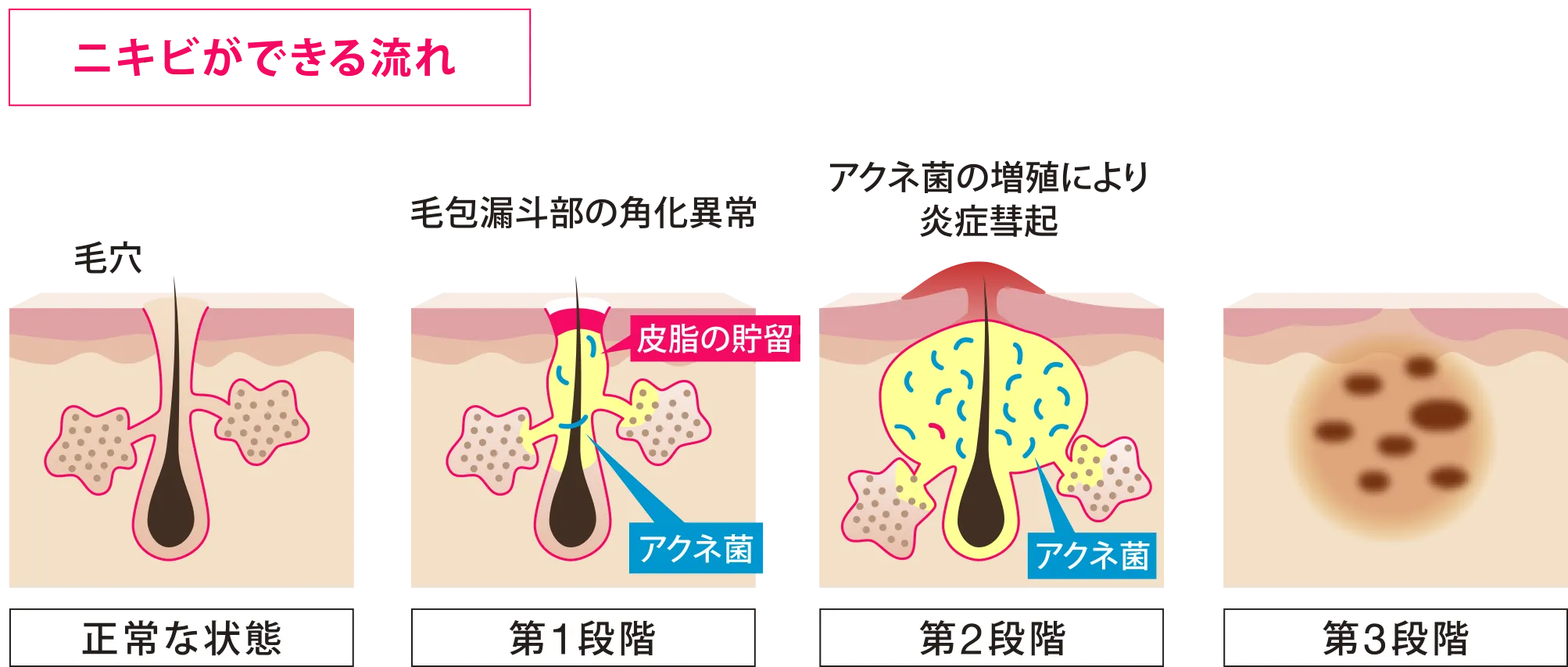 にきびができる流れ