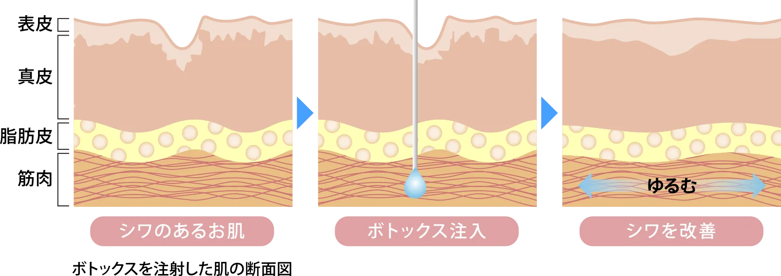 ボツリヌストキシン注入