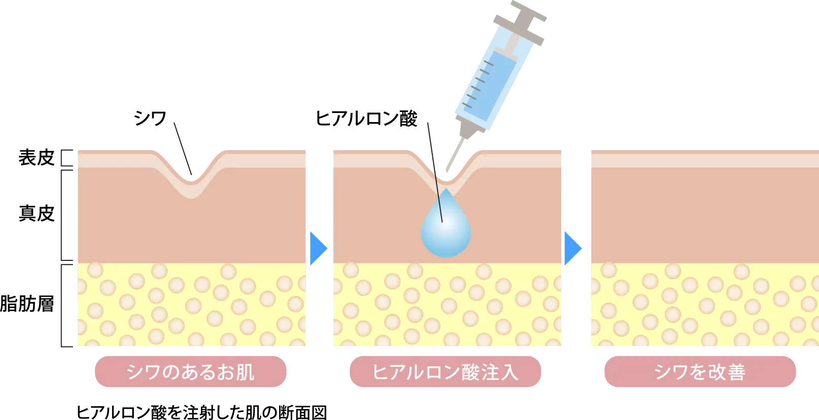 ヒアルロン酸注入