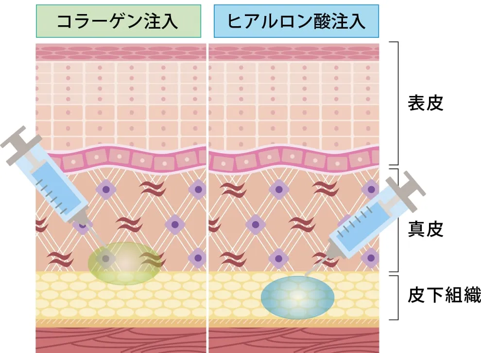 ベビーコラーゲン注入