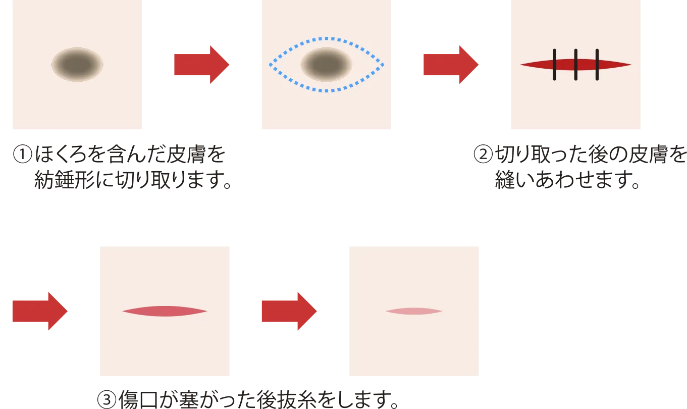 ほくろ切除