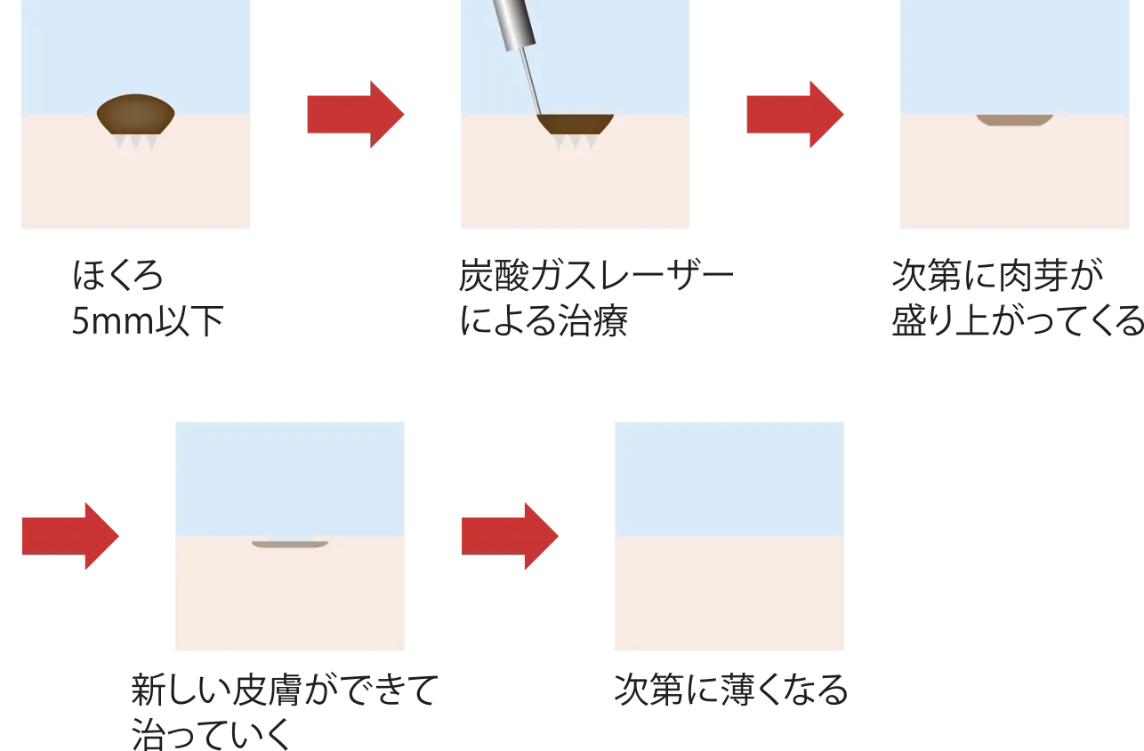 ほくろ炭酸ガスレーザー除去